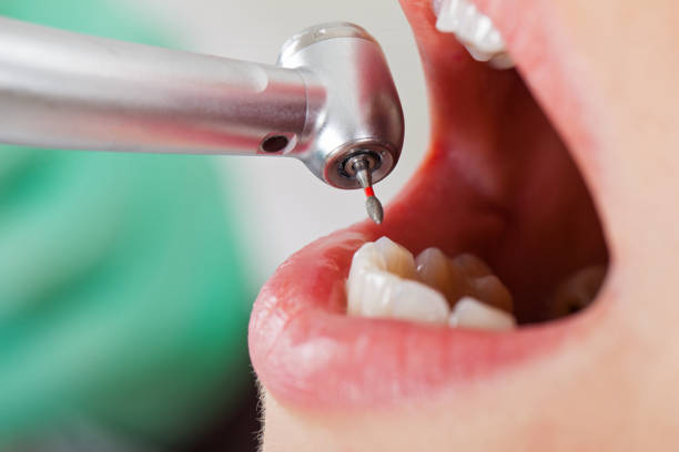 Best Emergency Wisdom Tooth Extraction in Springhill, LA